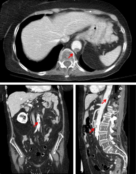 Mural Thrombus: Diagnosis and Treatment Options 